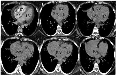 Case Report: Multi-Modality Imaging of a Right Atrial Pseudoaneurysm in a Patient With Breast Cancer